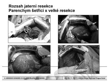 Limity resekcí pro jaterní metastázy kolorektálního karcinomu 4.
