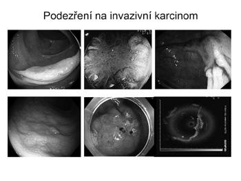 Endoskopická léčba 78 4.