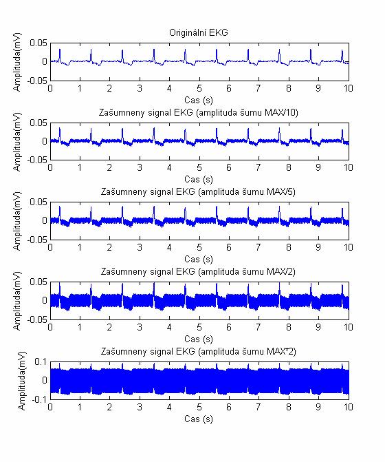 zašuměn s amplitudou šumu, která je rovna 1/10 amplitudy signálu až po dvojnásobek amplitudy. Je patrné jak velikost šumu ovlivňuje čitelnost signálu EKG.