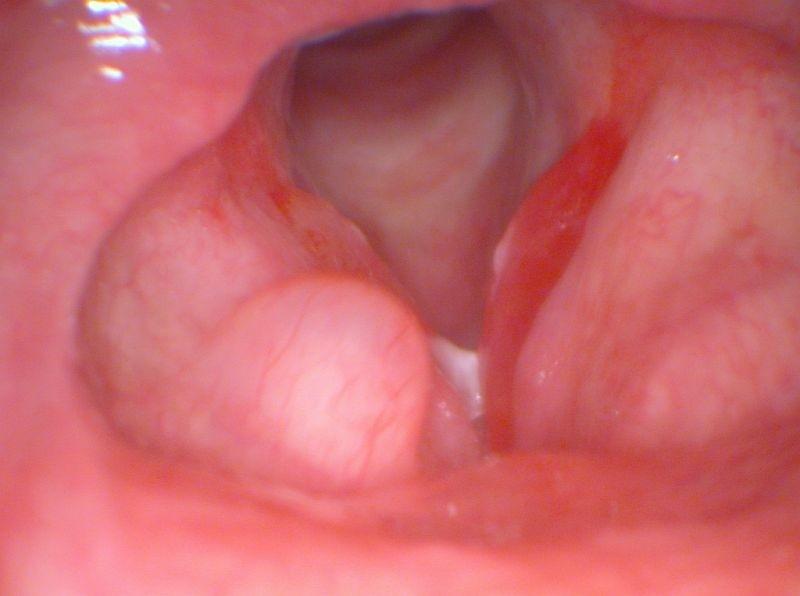 Laryngitis acuta Převzato z Becker a kol.