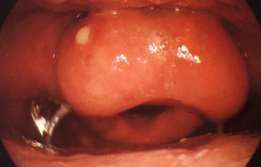Absces epiglottis Převzato z Becker a kol.