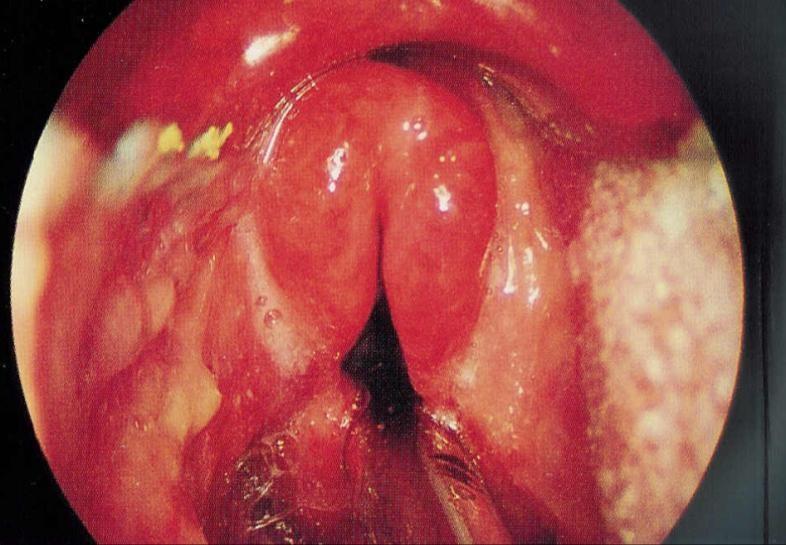 Akutní supraglotická laryngitida - epiglottitis Hemophilus influenzae inspiratorční