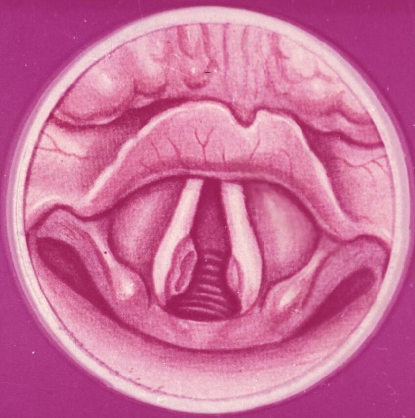Laryngitis