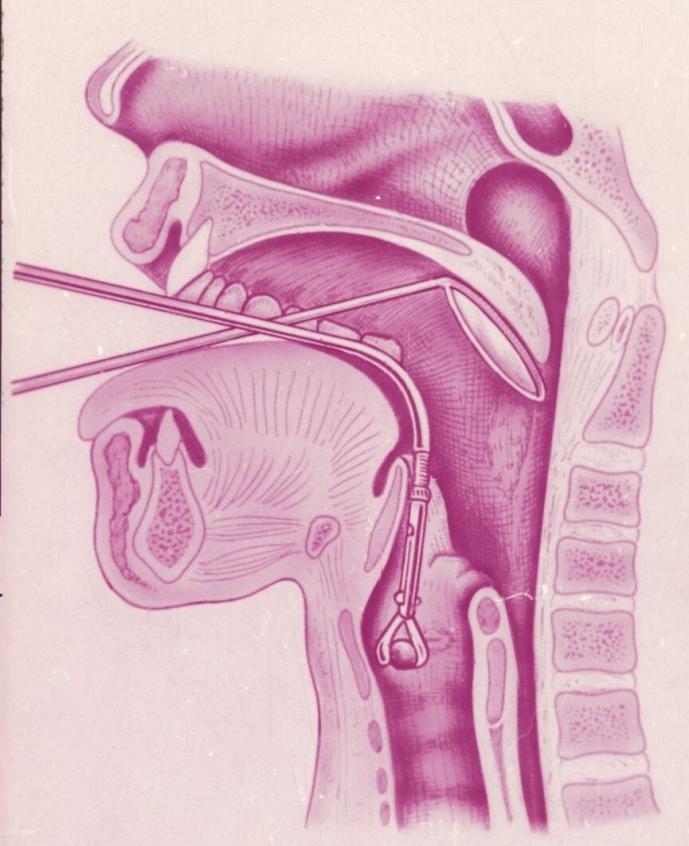 Polyp