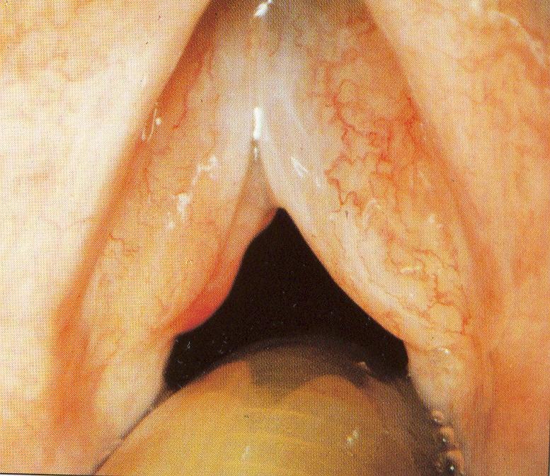 LARYNGITIS