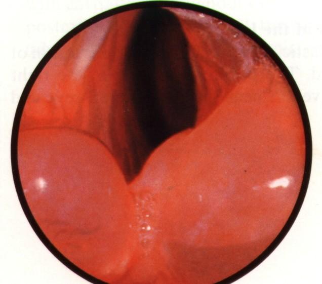 Oedema