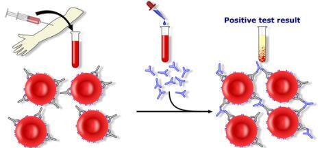 Tím dochází k aglutinaci erytrocytů, eventuálně k aktivaci komplementu. (21) PAT se používá při AIHA, HON, hemolytické potransfuzní reakci nebo u skupinově neshodné transplantace.