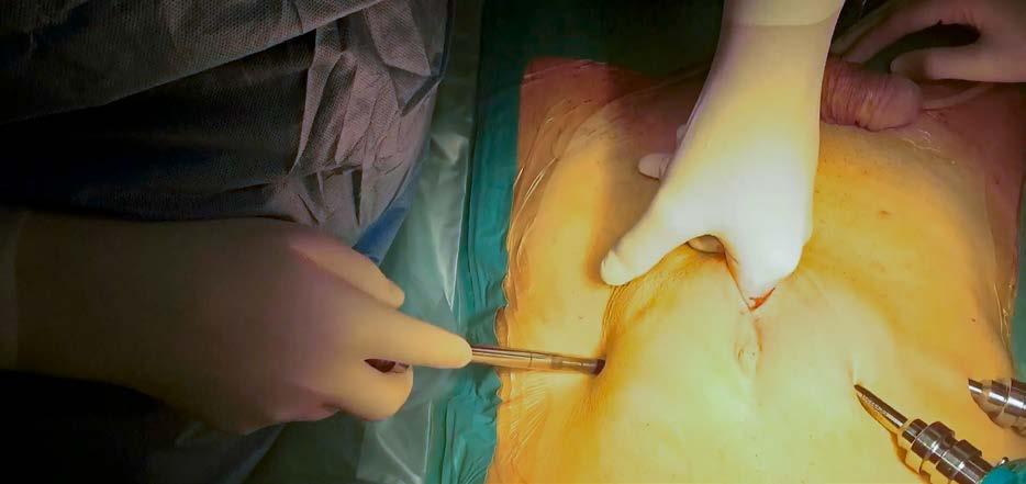 84 VIDEO EXTRAPERITONEÁLNÍ ROBOTICKÁ RADIKÁLNÍ PROSTATEKTOMIE S BILATERÁLNÍM ŠETŘENÍM NERVOVĚ CÉVNÍCH SVAZKŮ Extraperitoneal robotic radical prostatectomy with bilateral sparing of neurovascular
