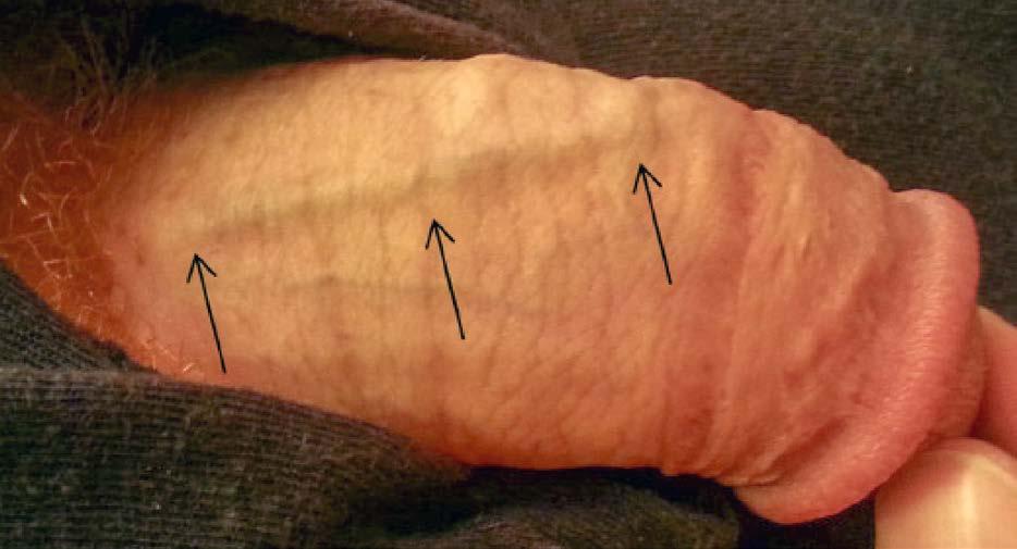 124 ORIGINÁLNÍ PRÁCE Obr. 1. Tuhý pruh v průběhu dorzální žíly Ilustrativní foto zdroj (9) Fig. 1. Palpable rigid stripe affecting the dorsal vein Obr. 2.