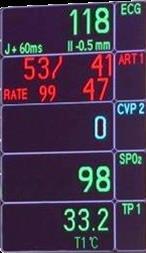 (Sakamotol, Thromb Haemost 2000; Knobler, Thromb Res 1998; Gresele, J Am Coll Cardiol 2003) způsobuje endoteliální
