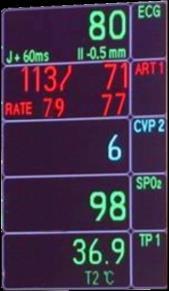 rozsah renálního postižení u pacientů po kardiochirurgickém (Meldrum, J Surg Res 1999; Van den Berghel, N Engl J Med
