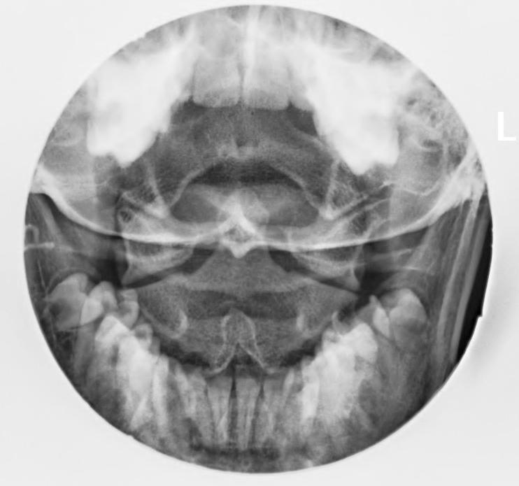 baze dentu přesahování laterálních okrajů C1