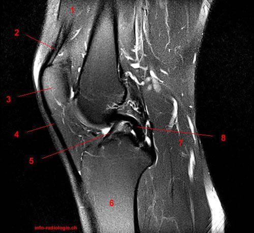MR kolena Sagittal, T2-weighted 1, Vastus medialis muscle 2, Quadriceps tendon 3, Patella 4, Patellar