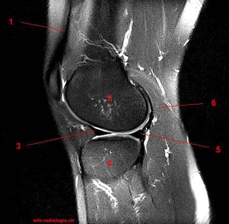 Sagittal, T2-weighted 1, Quadriceps tendon 2, Femur 3, Lateral meniscus, anterior