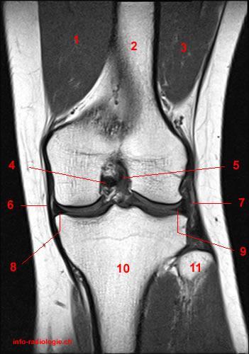 Coronal T1-weighted images 1, Vastus medialis muscle 2, Femur 3, Vastus lateralis muscle 4, Posterior cruciate ligament 5, Anterior