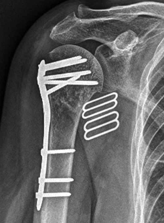 66/ a b Obr. 3. Srovnání základní montáže dlahové osteosyntézy čtyřúlomkové zlomeniny proximálního humeru: a limitovaný transdeltoideální přístup, b deltoideopektorální přístup.