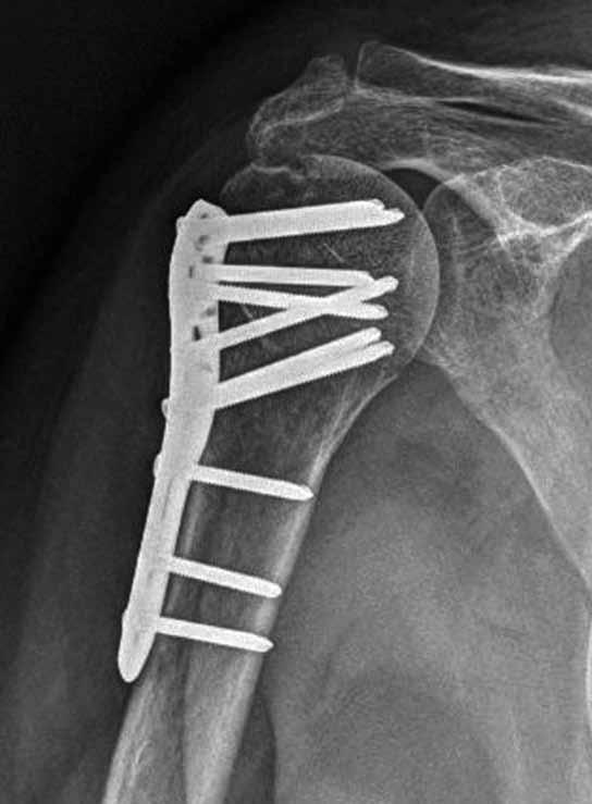 Povzbudivé výsledky miniinvazivní dlahové osteosyntézy vedly k postupnému nárůstu použití této techniky (2, 8, 20). V současné době se již objevují práce s větším počtem operovaných pacientů.