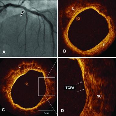 Příloha H: Koronární ateroskleróza při OCT TCFA-thin cap fibroatheroma, fibroaterom s tenkou fibrózní čepičkou; NC necrotic core nekrotické