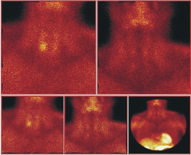 PRIMÁRNÍ HYPERPARATYREÓZA MANIFESTOVANÁ DESETILETOU ANAMNÉZOU VŘEDOVÉ CHOROBY hyperparatyreózu, kterou ovšem odlišíme na základě nízké či normální hladiny kalcia, a dále terciární hyperparatyreózu,
