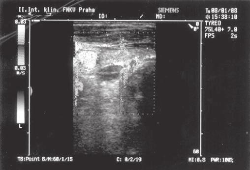 1), zahrnující malignity, granulomatózní procesy, jiné endokrinopatie (hypertyreózu, feochromocytom, adrenální insuficienci, syndrom MEN mnohočetné endokrinní neoplazie), iatrogenní vlivy (thiazidy,