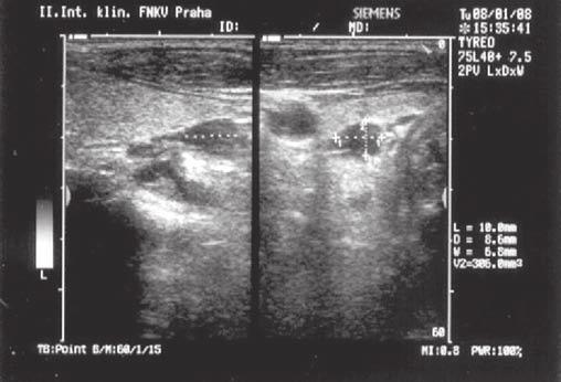 V případě laboratorního potvrzení PH je nutné provést lokalizační diagnostiku.
