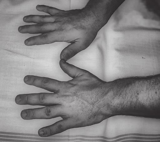 1988), s ekvivalentným postihnutím oboch pohlaví a vekom 40 60 rokov v čase diagnostikovania.