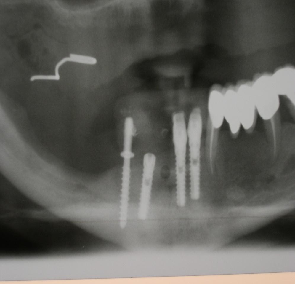14. OPT po odebrání tkáně a nasazení implantátu