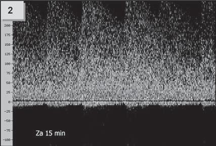 Za 15 min od zahájení TL zachycena ACM vlevo s obrazem těsné stenózy (2), během 40min podávání t-pa úplná úprava toků v této tepně (3), sledovaná plnou úpravou klinického stavu.