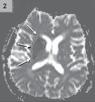 DWI, PWI). DWI sekvence (difuzně vážené snímky) zobrazují poruchu transportu molekul vody (resp. protonů), ke kterému při mozkové ischémii dochází.