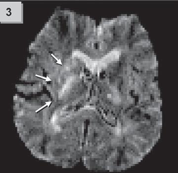 PWI sekvence (perfuzně vážené snímky) podávají informace o aktuálním prokrvení mozkové tkáně. Objem tkáně s postiženou perfuzí v sobě zahrnuje oblast již dokonaného infarktu a současně i penumbru.