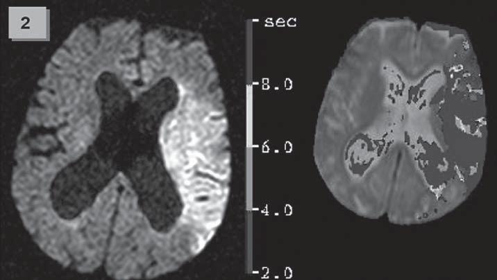 Po terapii došlo k masivnímu intracerebrálnímu krvácení s provalením do komor a exitu v průběhu 48 hodin (mrs 2) po 90 dnech bylo v případě pacientů léčených r-pro UK dosaženo ve 40 % případů, v