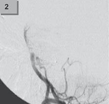 Dle angiografie prokázán trombotický uzávěr proximální a. basilaris v místě odstupu pravé AICA a jejích distálních větví (1).