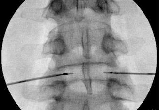 Intradiscal biacuplasty Intradiskální bipolární RF