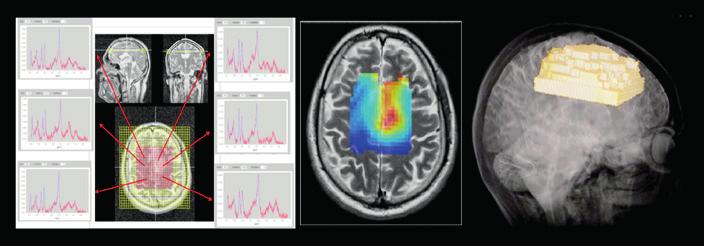 NEUROONKOLOGIE Onemocnění gliomovým nádorem postihne v České republice zhruba 700 pacientů ročně.