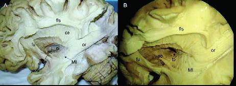 Dalším četným neuroonkologickým onemocněním s nepříznivou prognózou jsou mozkové metastázy.