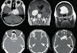 CHIRURGIE BAZE LEBNÍ SPONDYLOCHIRURGIE (CHIRURGIE PÁTEŘE) Chirurgie lební baze se zaměřuje na patologie a operační přístupy v oblasti spodiny lebeční.