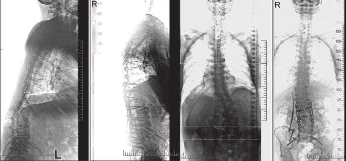 Další velkou skupinou jsou úrazy páteře, kde se neurochirurgie specializuje na ošetřování pacientů s poraněním cervikokraniálního přechodu, krční páteře, cervikothorakálního přechodu a sacra.