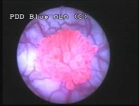 Fluorescenční cystoskopie může vést k detekci uroteliálních lézí, které nejsou normálně zřetelné (CIS a malé papilární TCC) Princip fluorescence: přítomnost fotosenzitivní substance