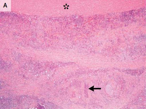 Obrázek 4: Histopatologické nálezy u IgG4 asociovaných onemocnění