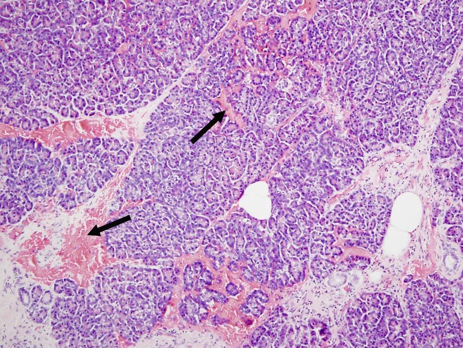 Obrázek 5: Akutní pankreatitida Pankreatická tkáň má lobulární architekturu.