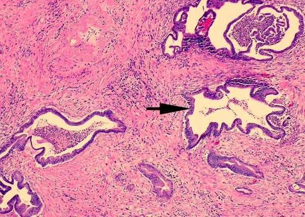 Obrázek 6: Histologický obraz CP adenokarcinomu Převzato a upraveno z [https://www.pathpedia.com]) 4.