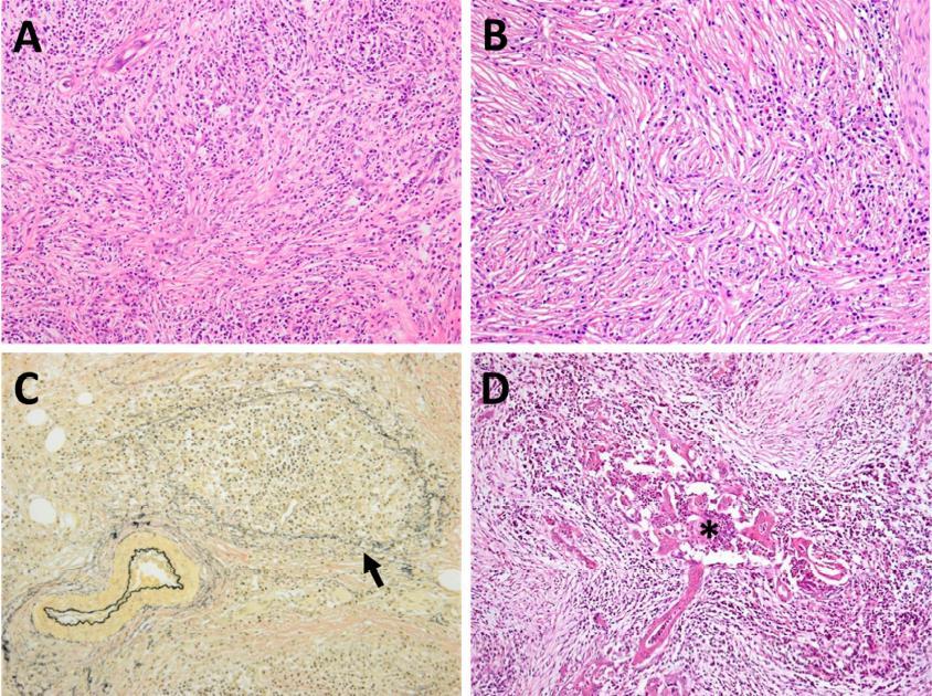 Obrázek 7: Histopatologické vzorky pankreatu od pacientů s AIP (A-C) idiopatická duktální pankreatitia (D), A) lymfoplasmacytický zánět, B) storiformní fibróza, C) obliterující flebitida (označená