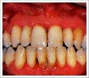 Obr. 27: Porovnání zdravé dásně s dásní, kde je přítomen zánět (parodontitis). zdravá dáseň zánět dásně (parodontitis) zdroj:http://www.mellmanperiodontics.