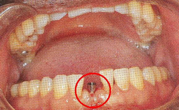 Obr. 31: Rekonstrukce zubu samostatnou korunkou.