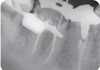Překrytí pulpy Perforace dna dřeňové dutiny Pulpotomie Resorpce Apexiﬁkace Apikální uzávěr Zaplnění konce kořene Perforace lokalizována v cervikální třetině mezio-bukálního kanálku POCÍTÍTE ROZDÍL