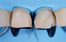 Díky svému předtvarování se Unica správně adaptuje na různé morfologie předních zubů a umožňuje současnou opravu interproximálních a krčkových okrajů, a to i v přítomnosti kofferdamu nebo gigiválních