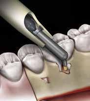 * BV/TV : trabecullae volume / total volume Vstřebatelná kolagenová membrána pro dentální chirurgii * Tb.