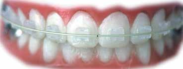 Hu-Fa Dental Hu-Fa úsměvy Informační časopis pro stomatologickou praxi Polar Roth zámky Kompozitní estetické zámky vyrobené ze zdravotnického polyurethanu.