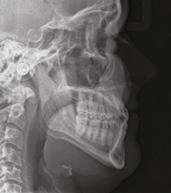 11: Panoramatický snímek po léčbě Figure 11: Post-treatment panoramic image Horní čelist Maxillary Dolní čelist Mandibular Malokluze Malocclusion Set-up Setup Mezi špičáky / Inter Canine 30.8 mm 32.