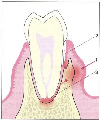 Obrázek č. 6: Parodontální absces. 1 gingivální absces, 2 parodontální absces, 3 periapikální absces. Zdroj: KOVAL OVÁ, E., ŤAPAJOVÁ, Z. Parodontológia I. 1. vyd.